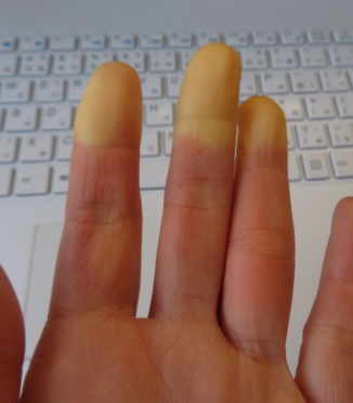 Zespół Raynauda i sen — dlaczego w nocy marzną ręce i nogi i jak z tym walczyć