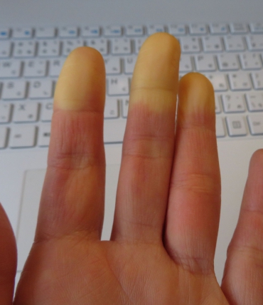 Zespół Raynauda i sen — dlaczego w nocy marzną ręce i nogi i jak z tym walczyć